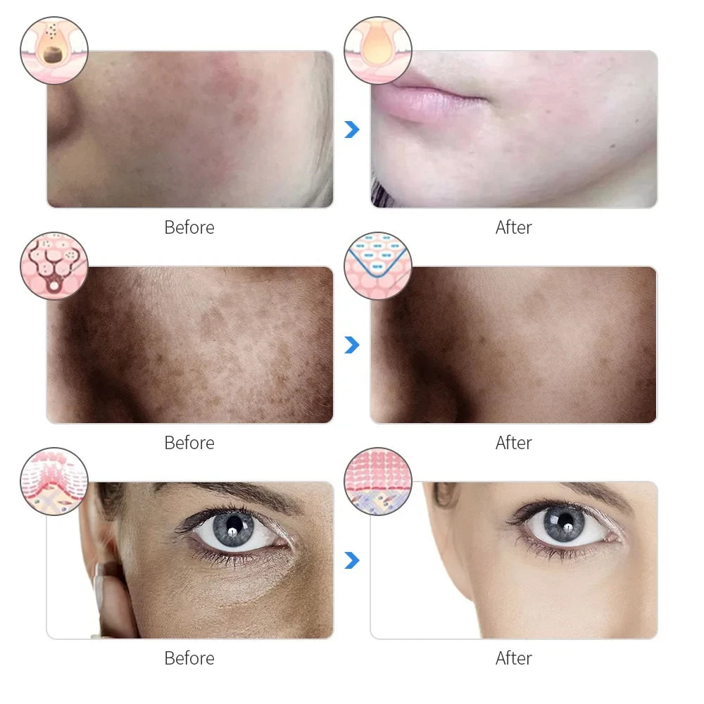 Rechargeable LED Photon Facial Mask